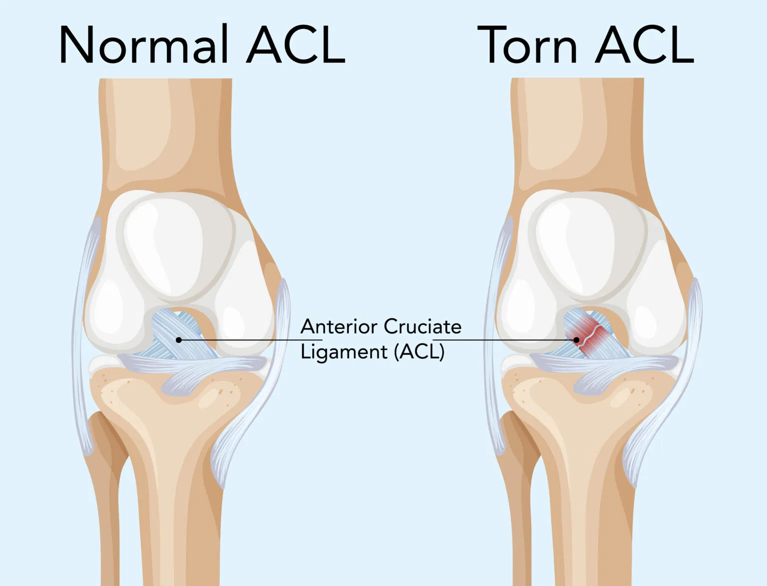 Tennis Elbow Treatment
